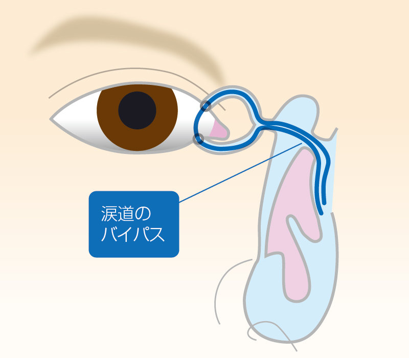 涙嚢鼻腔吻合術（DCR）